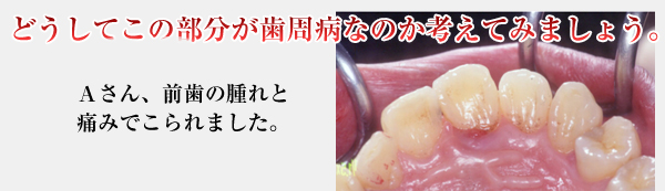 どうしてこの部分が歯周病なのか考えてみましょう