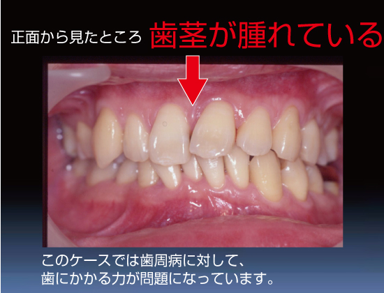 歯茎がはれている