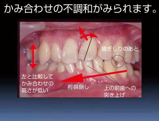 かみ合わせの不調和がみられます。