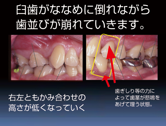 臼歯がななめに倒れながら歯並びがくずれていきます