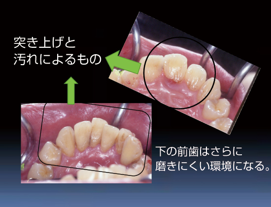 突き上げと汚れによるもの