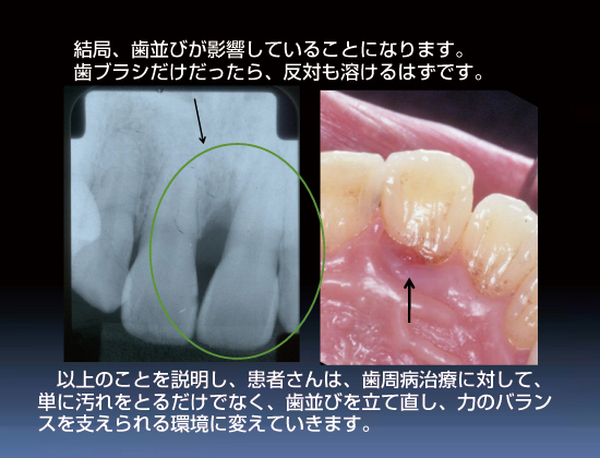 結局、歯並びが影響していることになります。