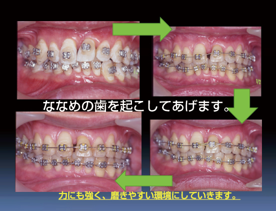 斜めの歯を興してあげます