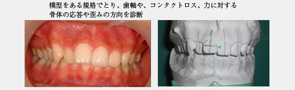 噛み合わせ・歯並び写真