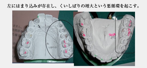 噛み合わせ・歯並び写真
