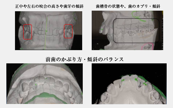 噛み合わせ・歯並び写真